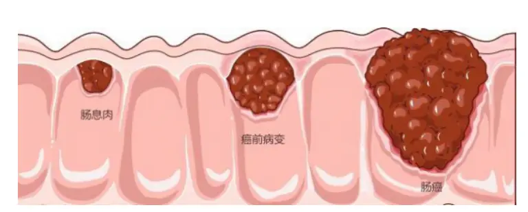 息肉